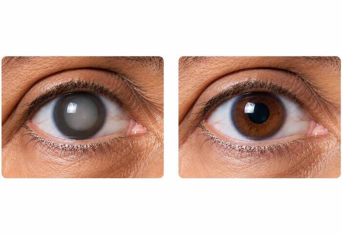 Cirurgia de Catarata (Facoemulsificação com Lentes Premium)