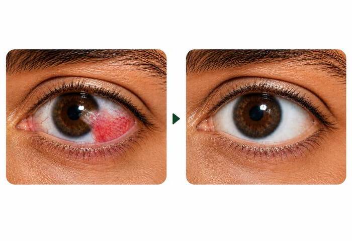 Cirurgia de Pterígio (com Cola Biológica) em São Luís