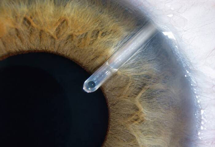 Tratamentos e Cirurgias para Glaucoma (TREC e MIBS) em São Luís