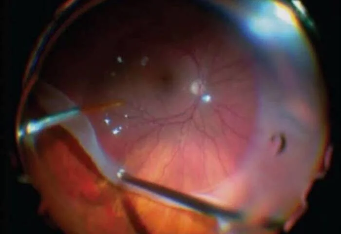 Vitrectomia Posterior (Retina e Vítreo)